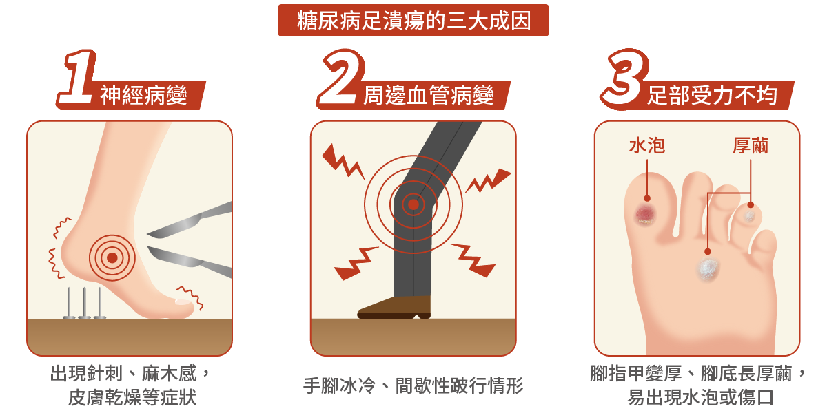 糖尿病足潰瘍的三大成因