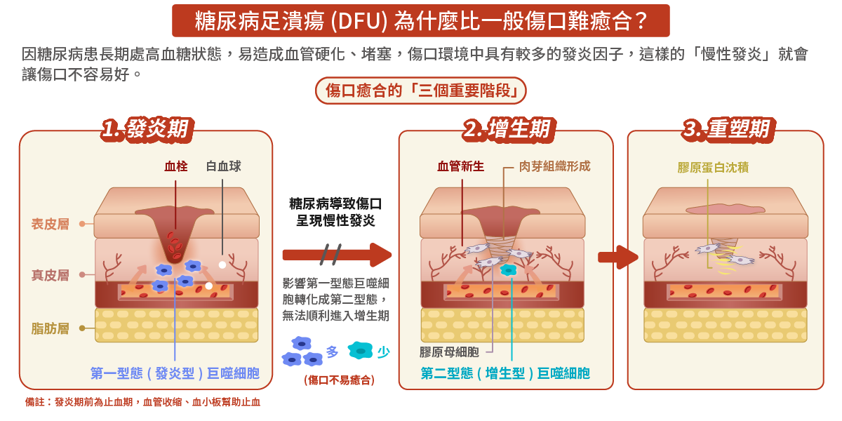 糖尿病足潰瘍(DFU)為什麼比一般傷口難癒合？