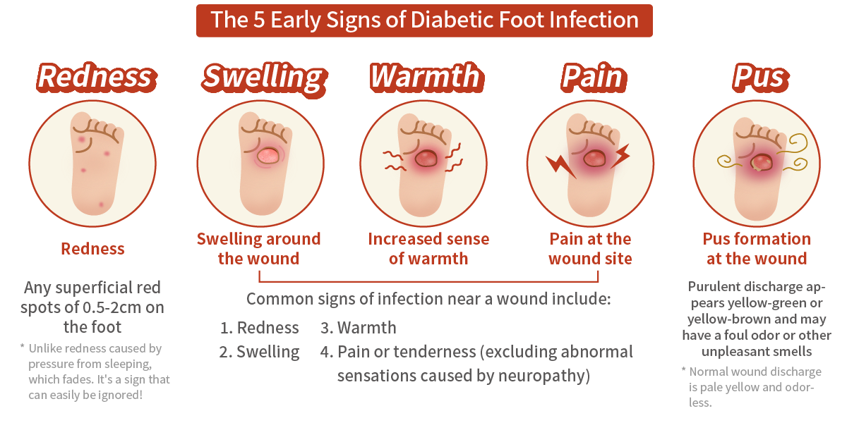 糖尿病足感染的五大早期征兆(红肿热痛脓)