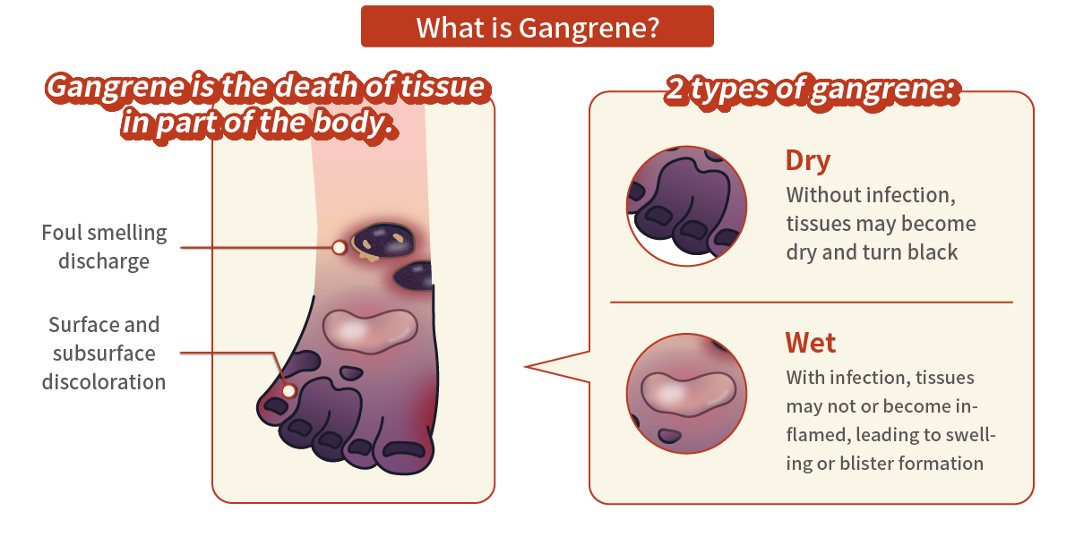 What is Gangrene?