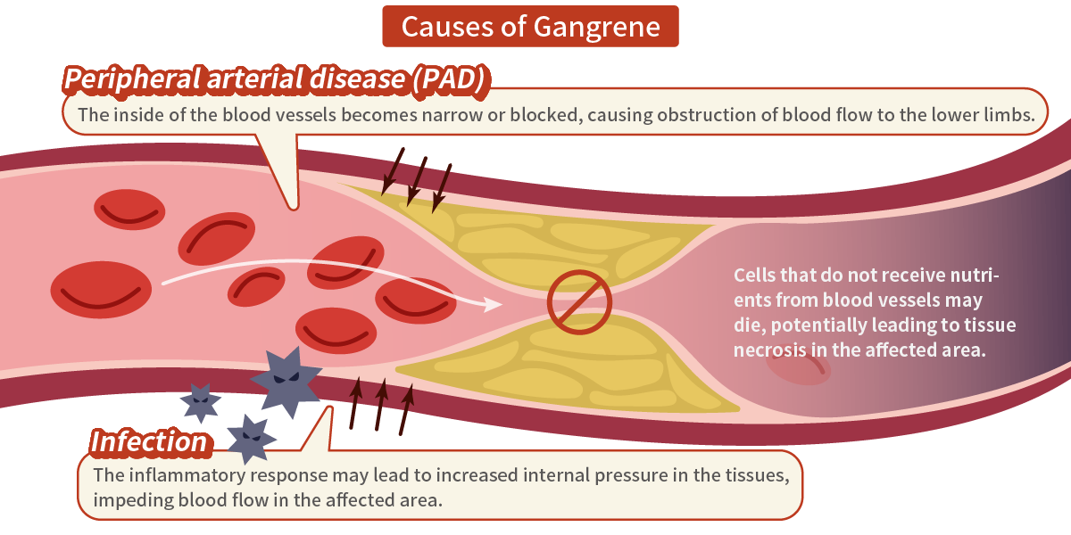 Causes of Gangrene