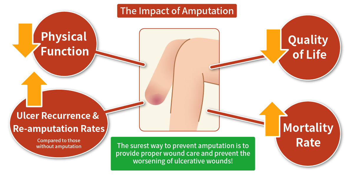 The Impact of Amputation