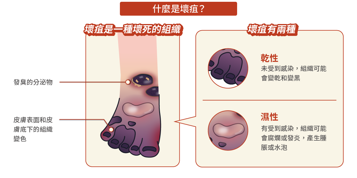 什麼是壞疽