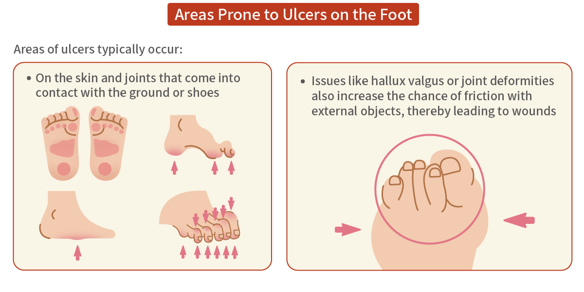 Areas Prone to Ulcers on the Foot