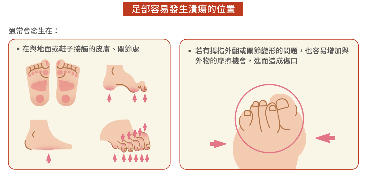 足部容易發生潰瘍的位置