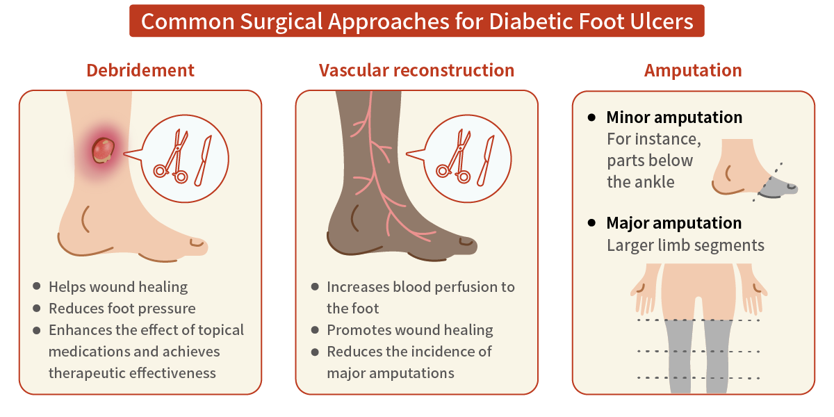 糖尿病足潰瘍的常見手術方式