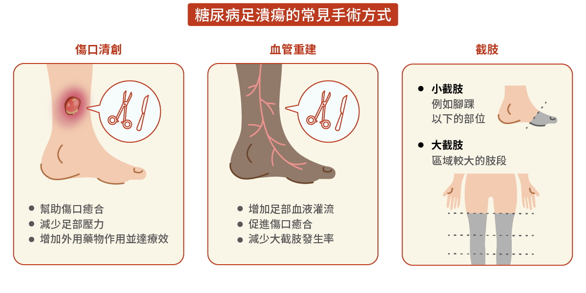 糖尿病足潰瘍的常見手術方式